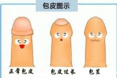 包皮过长一定要做手术吗？滨州男科在线答疑